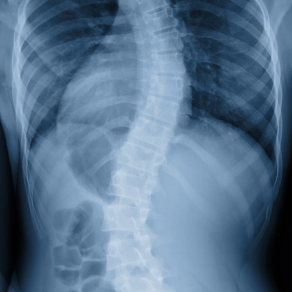 X-ray images showing typical signs of scoliosis