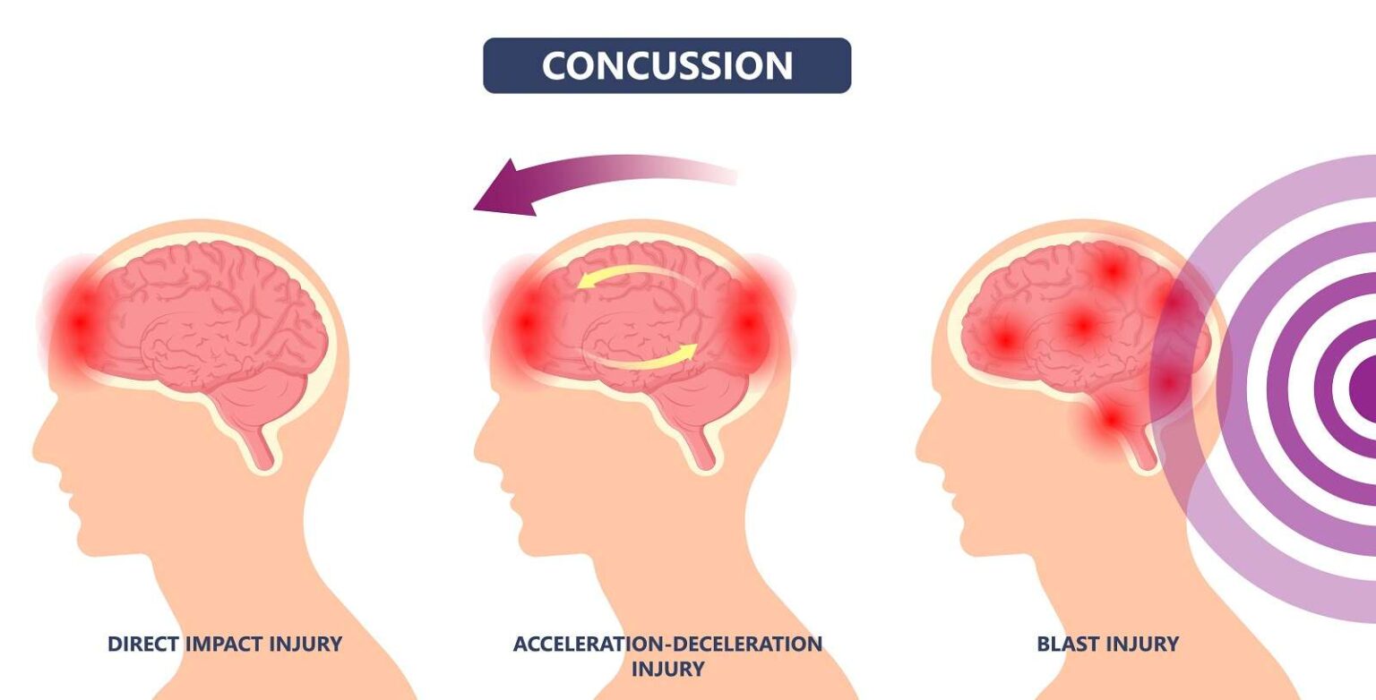 Concussion - Causes, Impact and Treatment - Medicine In Motion